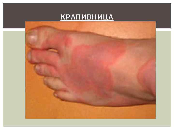 КРАПИВНИЦА 