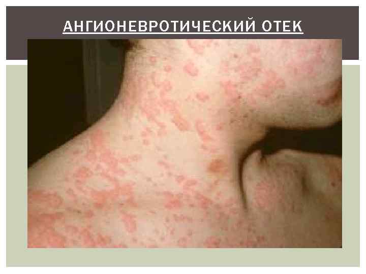 АНГИОНЕВРОТИЧЕСКИЙ ОТЕК (ОТЕК КВИНКЕ) 
