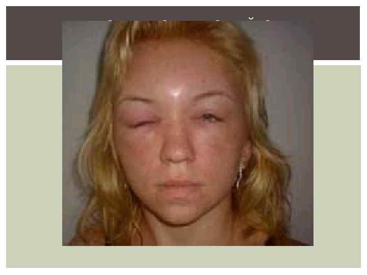 АНГИОНЕВРОТИЧЕСКИЙ ОТЕК (ОТЕК КВИНКЕ) 