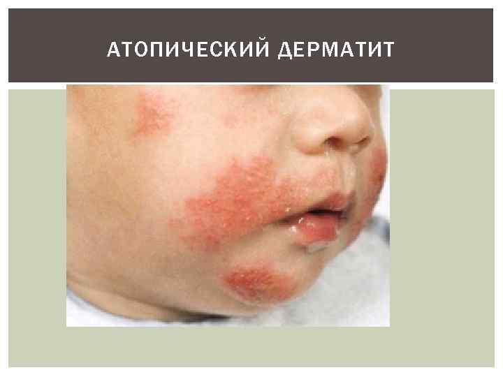 АТОПИЧЕСКИЙ ДЕРМАТИТ 