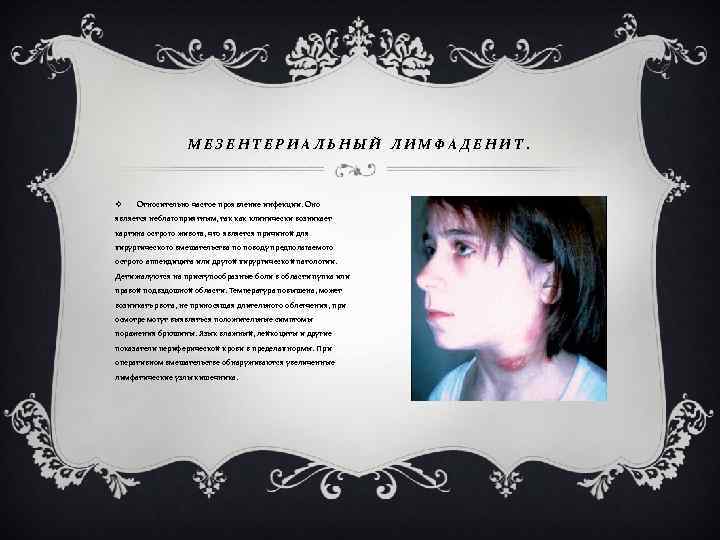 МЕЗЕНТЕРИАЛЬНЫЙ ЛИМФАДЕНИТ. v Относительно частое проявление инфекции. Оно является неблагоприятным, так клинически возникает картина