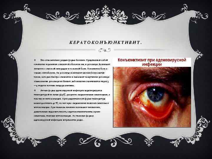 КЕРАТОКОНЪЮНКТИВИТ. v Это относительно редкая форма болезни. Представляет собой сочетание поражения слизистой оболочки век