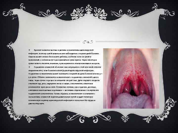 v Бронхит является частым и ранним осложнением аденовирусной инфекции, поэтому сухой кашель может наблюдаться