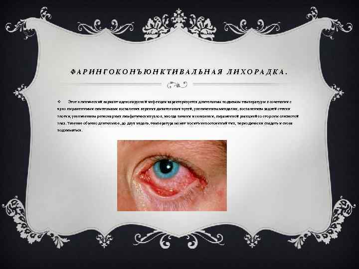 ФАРИНГОКОНЪЮНКТИВАЛЬНАЯ ЛИХОРАДКА. v Этот клинический вариант аденовирусной инфекции характеризуется длительным подъемом температуры в сочетании