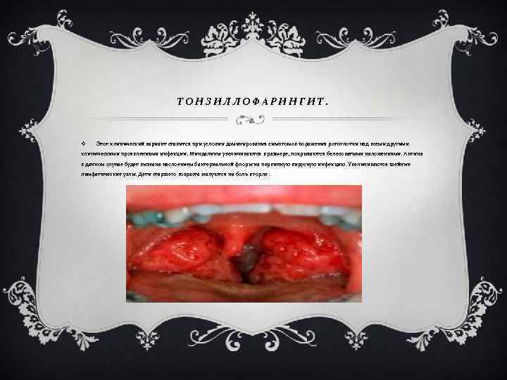 ТОНЗИЛЛОФАРИНГИТ. v Этот клинический вариант ставится при условии доминирования симптомов поражения ротоглотки над всеми