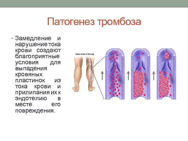 Механизмы тромбов