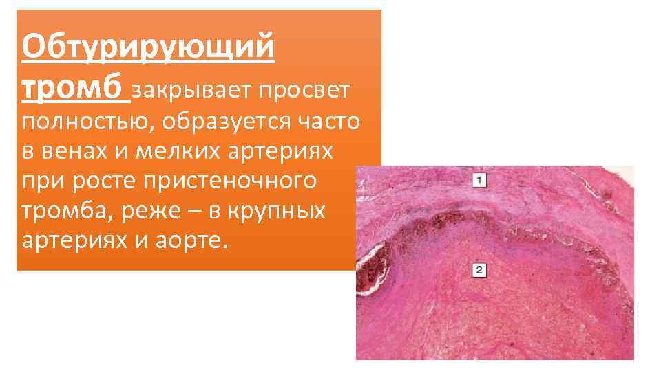 Обтурирующий тромб закрывает просвет полностью, образуется часто в венах и мелких артериях при росте