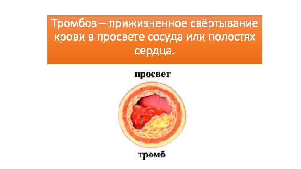 Схема образования сгустка в просвете сосуда