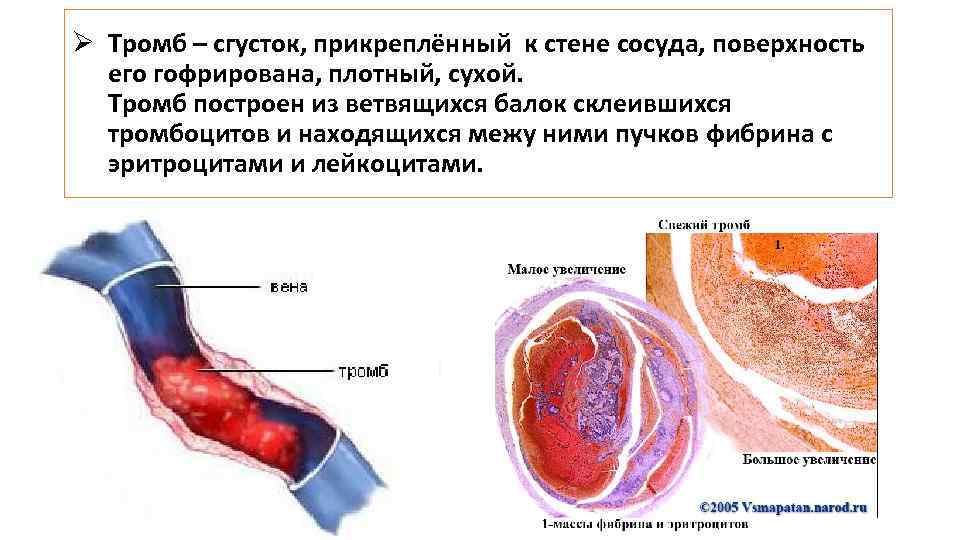 Ø Тромб – сгусток, прикреплённый к стене сосуда, поверхность его гофрирована, плотный, сухой. Тромб