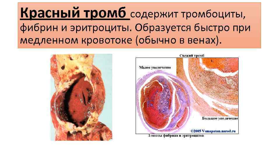 Красный тромб содержит тромбоциты, фибрин и эритроциты. Образуется быстро при медленном кровотоке (обычно в
