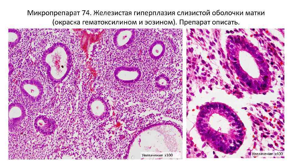 Гиперплазия переходит в рак. Гиперплазия эндометрия микропрепарат. Железистая гиперплазия слизистой оболочки матки. Гиперплазия матки гистология. Гиперплазия слизистой оболочки матки микропрепарат.