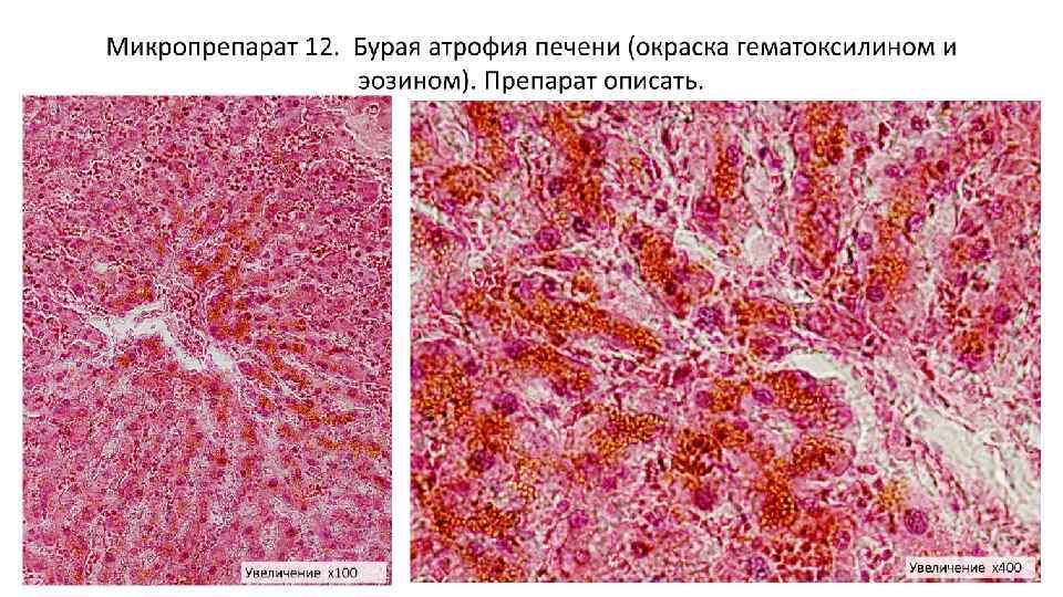 Липофусциноз печени патанатомия