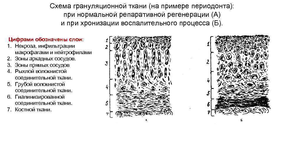 Схема грануляционной ткани (на примере периодонта): при нормальной репаративной регенерации (А) и при хронизации