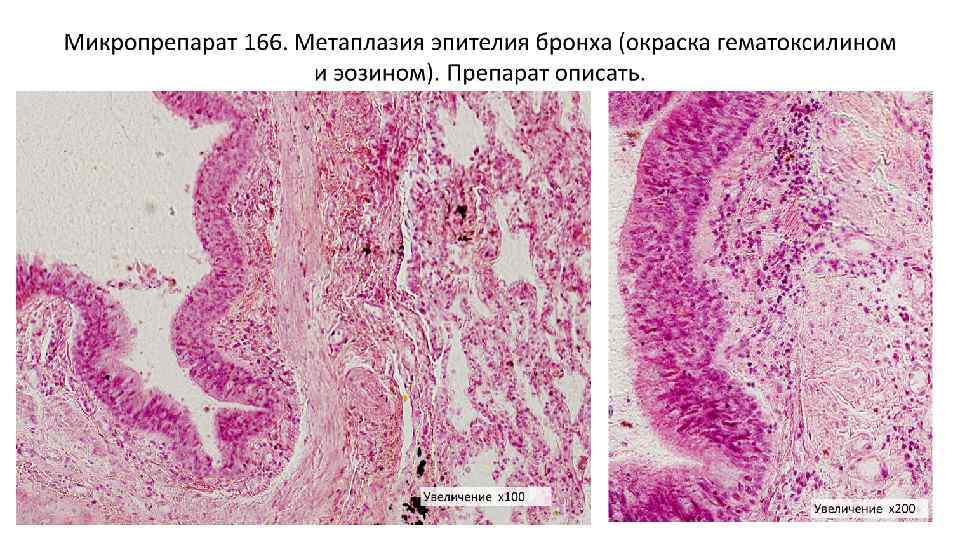 Эктопия с плоскоклеточной метаплазией. Метаплазия эпителия бронхов гистология. Хронический деформирующий бронхит микропрепарат. Плоскоклеточная метаплазия.