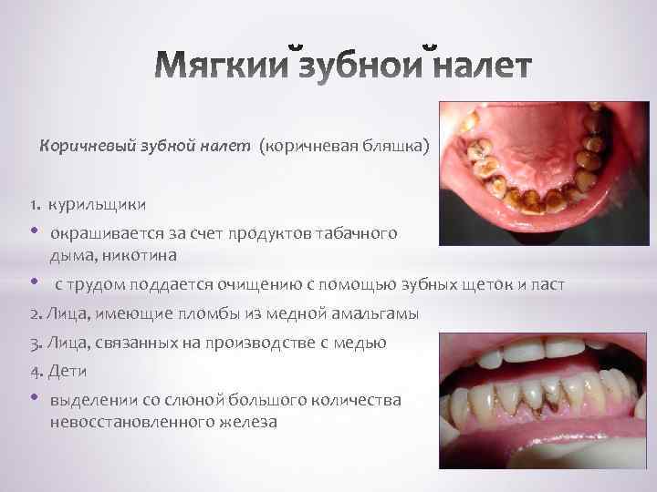  Коричневый зубной налет (коричневая бляшка) 1. курильщики • окрашивается за счет продуктов табачного