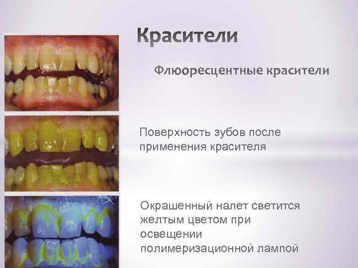  • Флюоресцентные красители красителя Поверхность зубов после применения красителя Окрашенный налет светится желтым