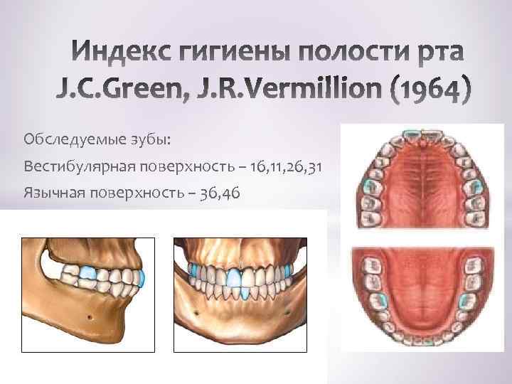 J. C. Green, J. R. Vermillion (1964) Обследуемые зубы: Вестибулярная поверхность – 16, 11,