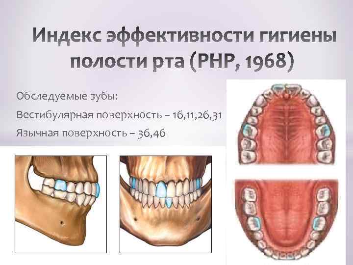 Обследуемые зубы: Вестибулярная поверхность – 16, 11, 26, 31 Язычная поверхность – 36, 46