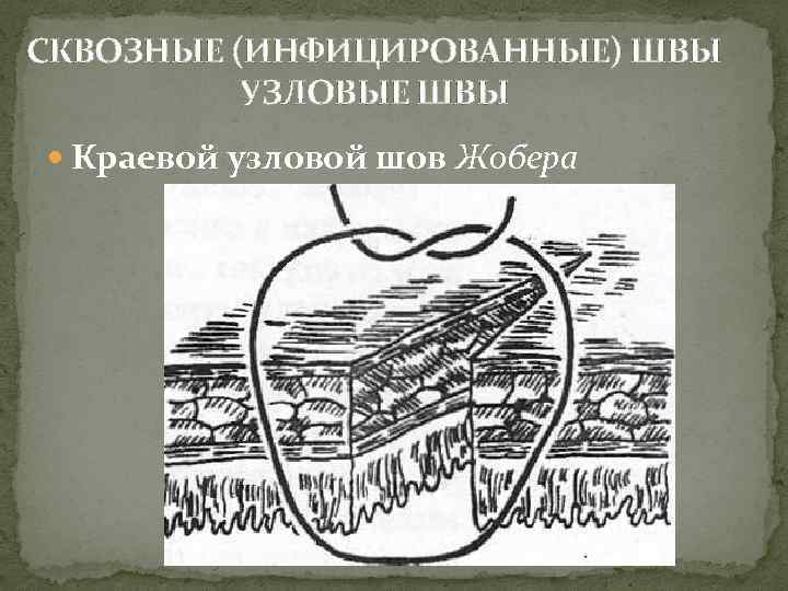 СКВОЗНЫЕ (ИНФИЦИРОВАННЫЕ) ШВЫ УЗЛОВЫЕ ШВЫ Краевой узловой шов Жобера 