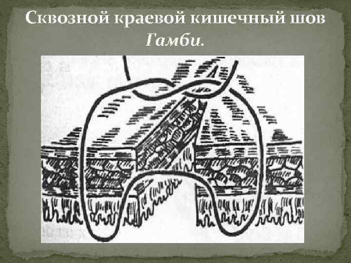 Сквозной краевой кишечный шов Гамби. 