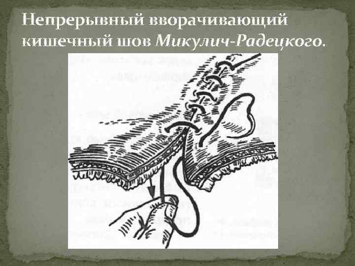 Кишечный шов. Шов фон Микулич-Радецкого. Непрерывные кишечные швы. Вворачивающий кишечный шов.