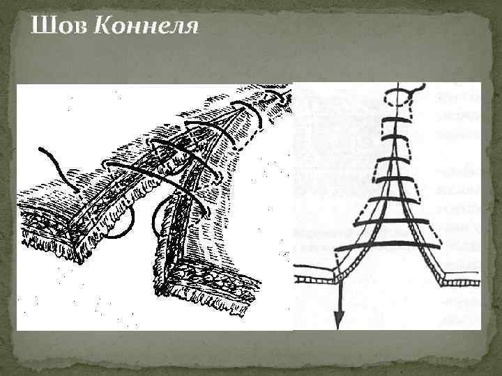 Шов Коннеля 