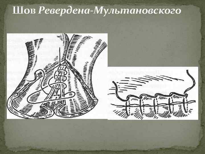 Шов мультановского схема