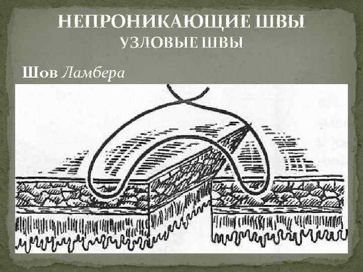 НЕПРОНИКАЮЩИЕ ШВЫ УЗЛОВЫЕ ШВЫ Шов Ламбера 
