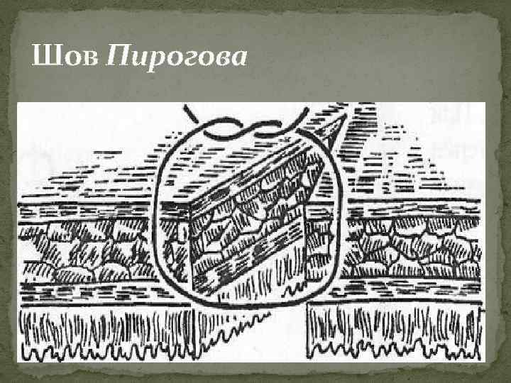 Шов Пирогова 