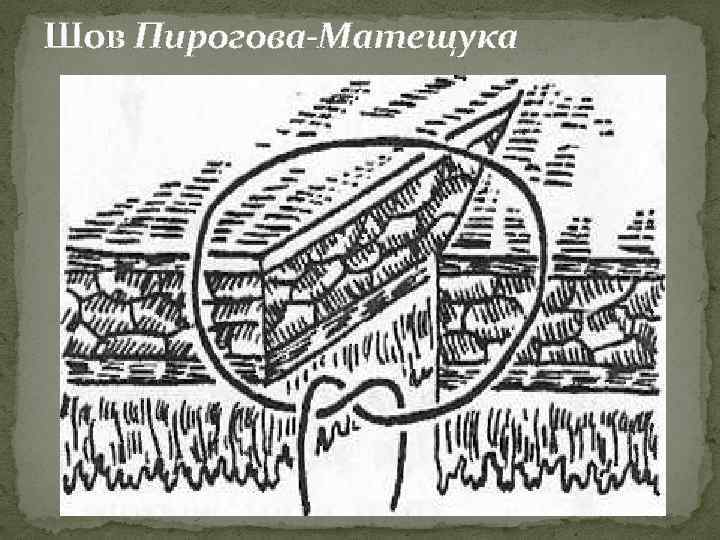 Шов Пирогова-Матещука 