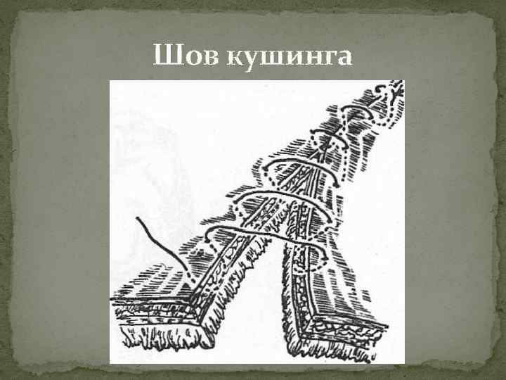 Шов кушинга 