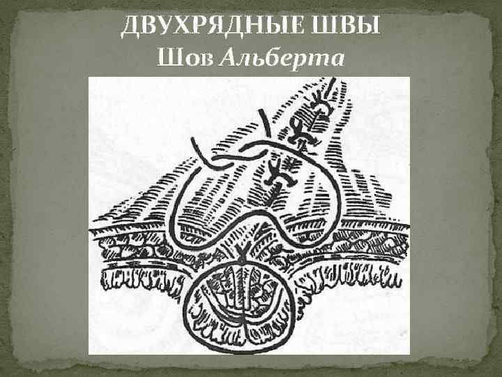 ДВУХРЯДНЫЕ ШВЫ Шов Альберта 