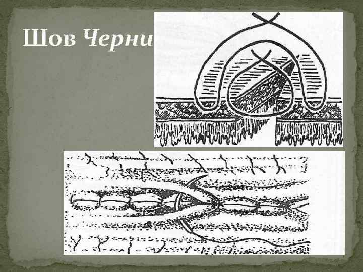 Кишечный шов. Двухрядный шов Пирогова черни. Шов Альберта черни. Кишечный шов Пирогова черни. Шов Ламбера и Пирогова.