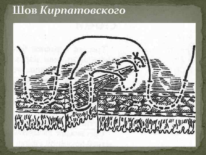 Шов Кирпатовского 