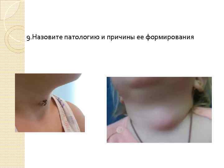9. Назовите патологию и причины ее формирования 