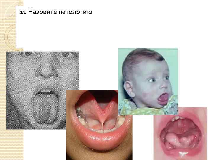 11. Назовите патологию 