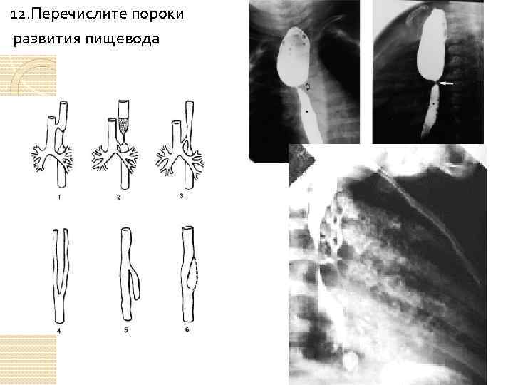 12. Перечислите пороки развития пищевода 