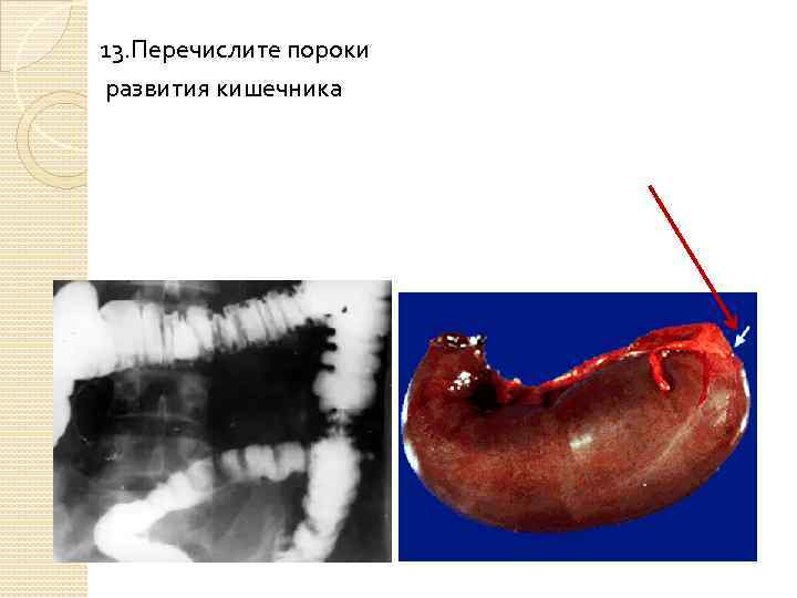 13. Перечислите пороки развития кишечника 