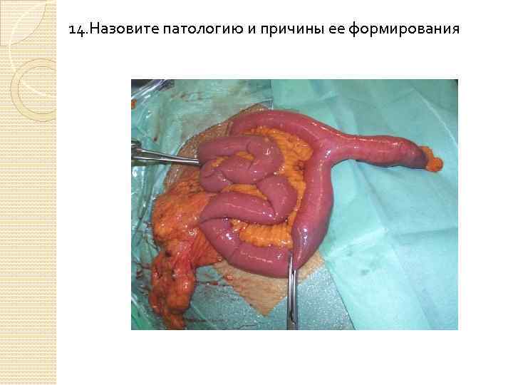 14. Назовите патологию и причины ее формирования 