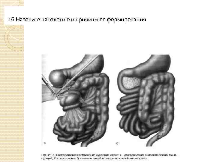 16. Назовите патологию и причины ее формирования 