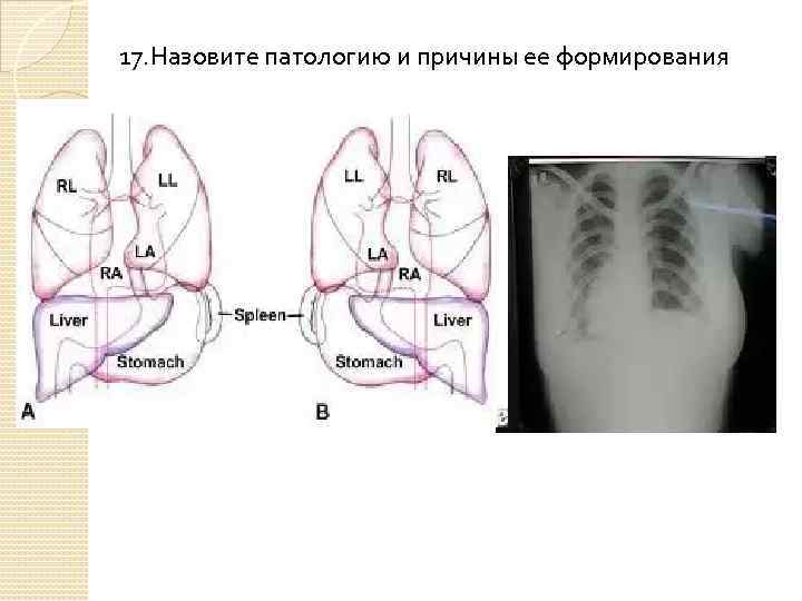 17. Назовите патологию и причины ее формирования 