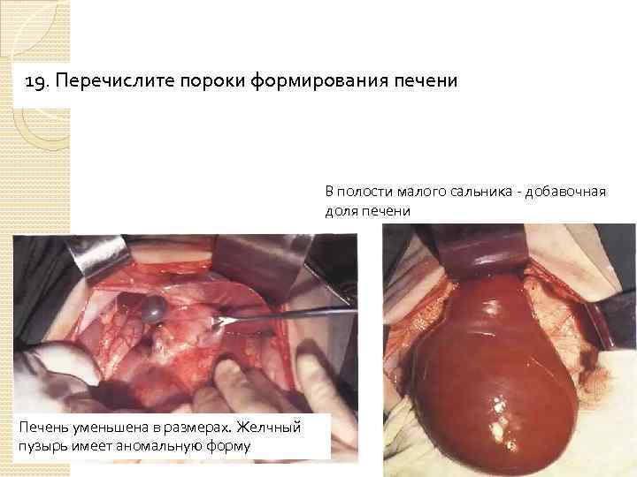 19. Перечислите пороки формирования печени В полости малого сальника - добавочная доля печени Печень