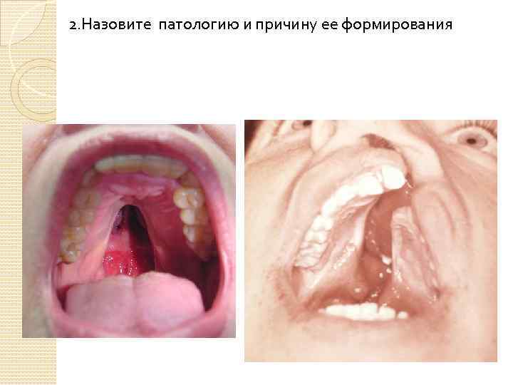 2. Назовите патологию и причину ее формирования 