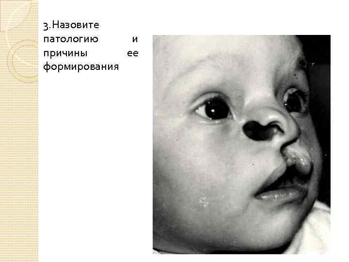 3. Назовите патологию и причины ее формирования 