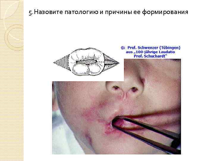 5. Назовите патологию и причины ее формирования 