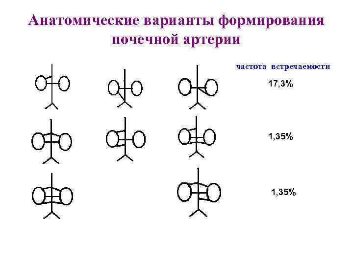 Анатомические варианты формирования почечной артерии частота встречаемости 17, 3% 1, 35% 