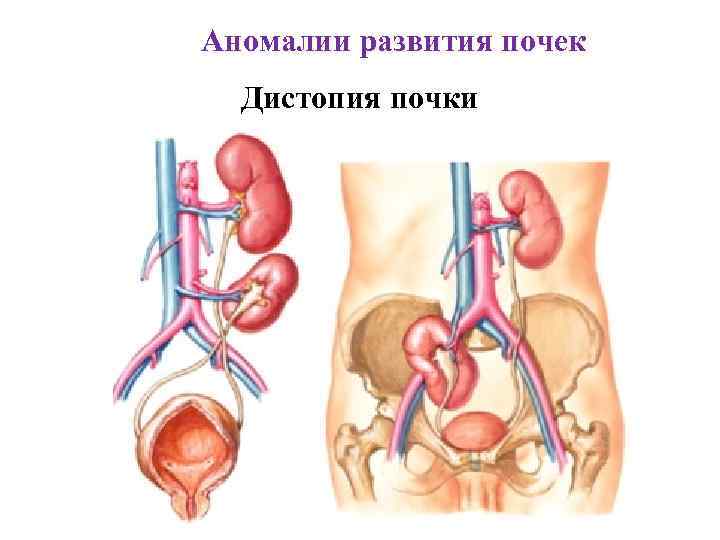 Аномалии развития почек Дистопия почки 