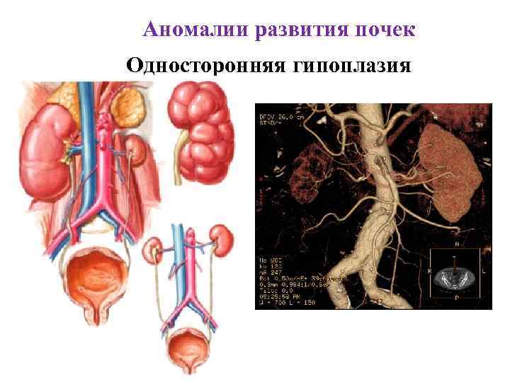 Аномалии развития почек Односторонняя гипоплазия 