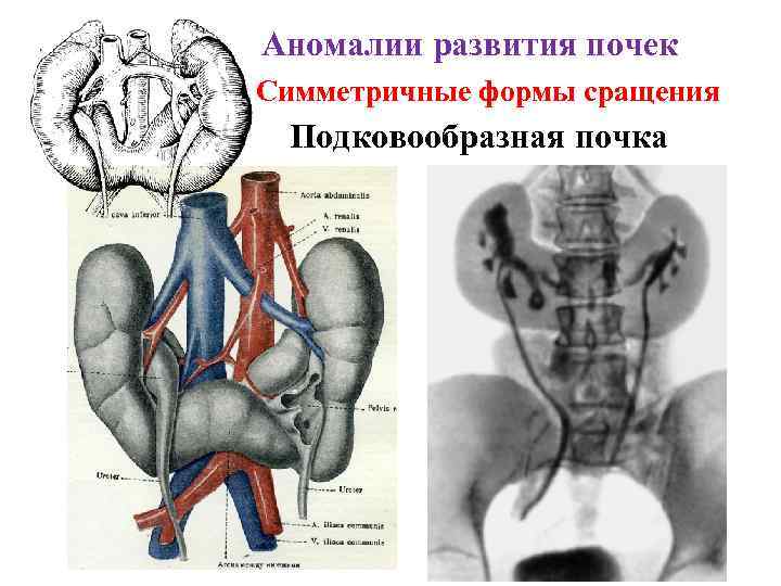 Аномалии развития почек Симметричные формы сращения Подковообразная почка 
