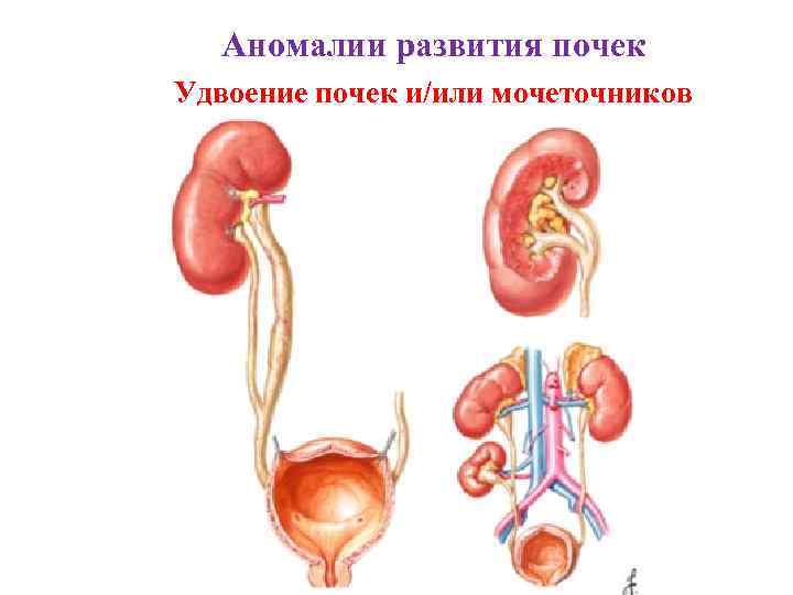 Аномалии развития почки картинки